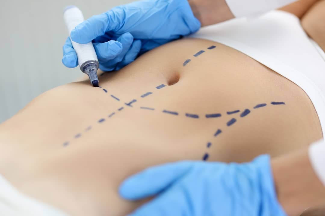 42923094 doctor drawing preoperative marking on patient abdomen closeupS