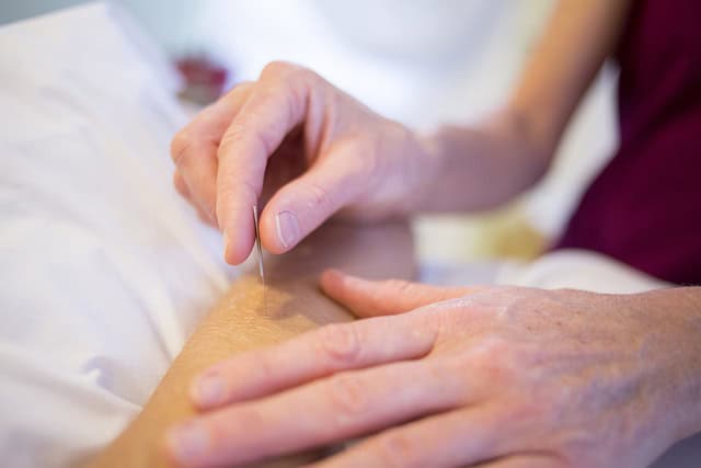 acupuncture 5126777 640