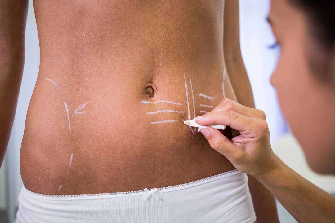 surgeon drawing lines womans abdomen liposuction cellulite removal optimized S